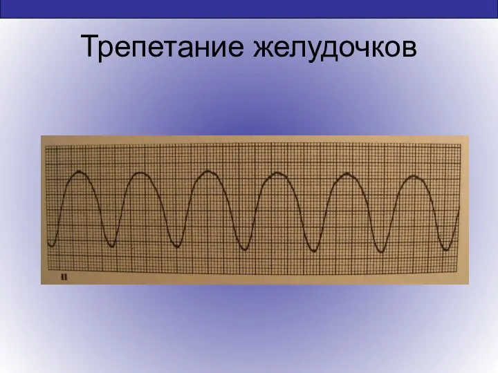 Трепетание желудочков