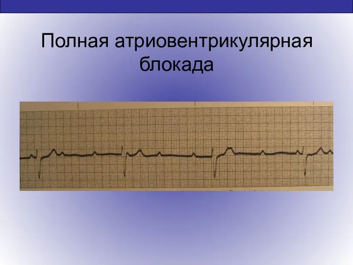 Полная атриовентрикулярная блокада