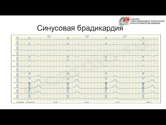 Синусовая брадикардия