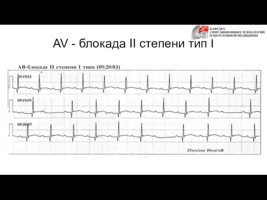 AV - блокада II степени тип I