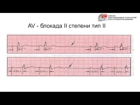 AV - блокада II степени тип II