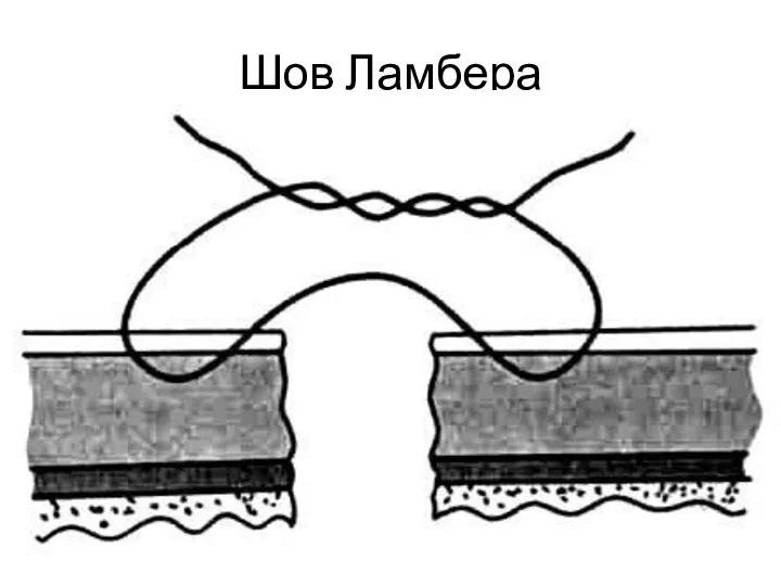 Шов Ламбера