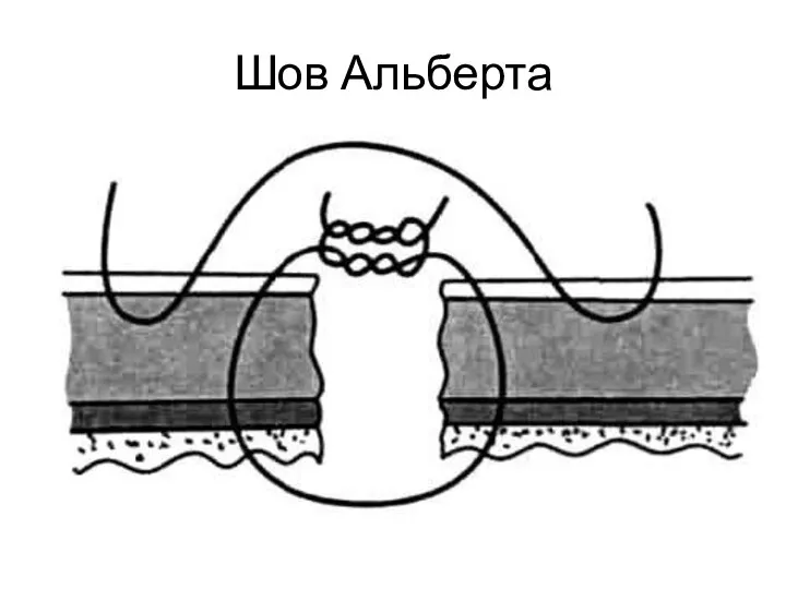 Шов Альберта