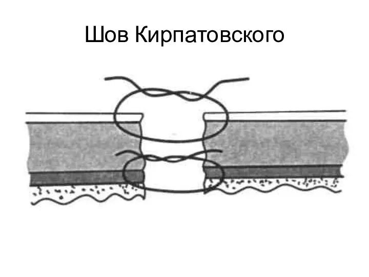 Шов Кирпатовского