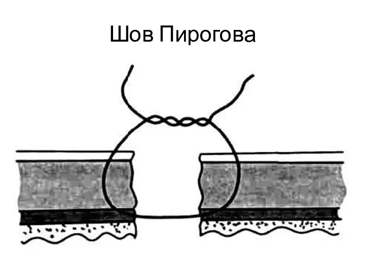 Шов Пирогова