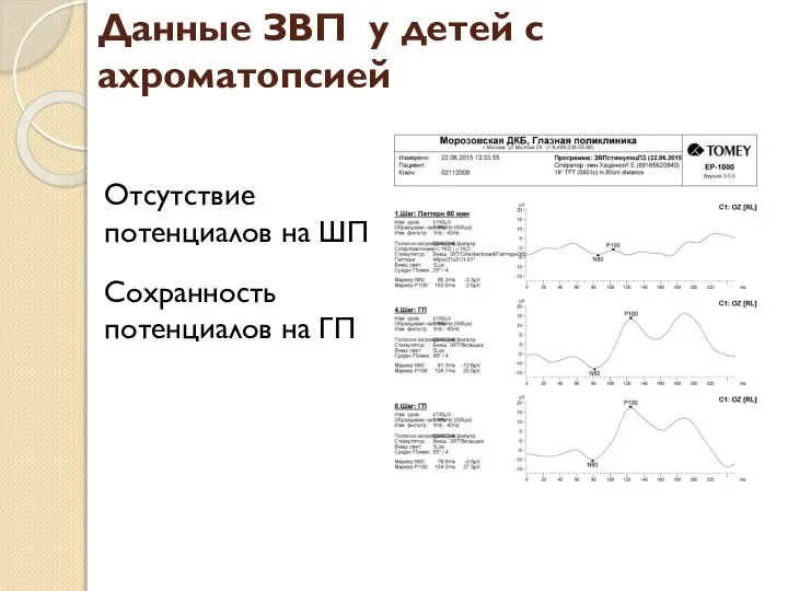 Данные ЗВП у детей с ахроматопсией Отсутствие потенциалов на ШП Сохранность потенциалов на ГП