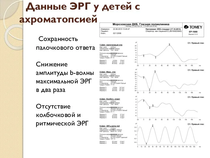 Данные ЭРГ у детей с ахроматопсией Сохранность палочкового ответа Снижение амплитуды b-волны