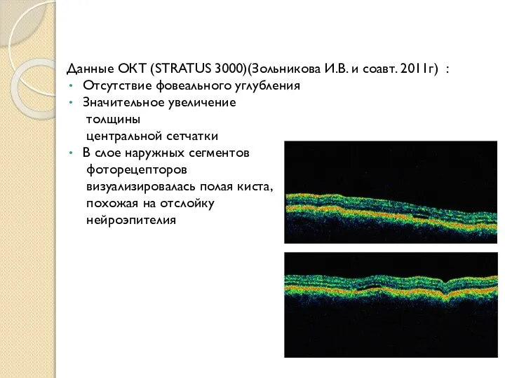 Данные ОКТ (STRATUS 3000)(Зольникова И.В. и соавт. 2011г) : Отсутствие фовеального углубления