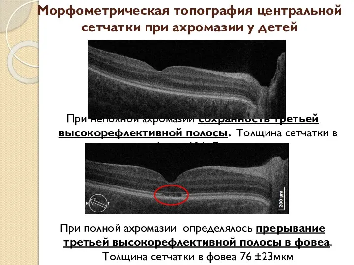 Морфометрическая топография центральной сетчатки при ахромазии у детей При неполной ахромазии сохранность