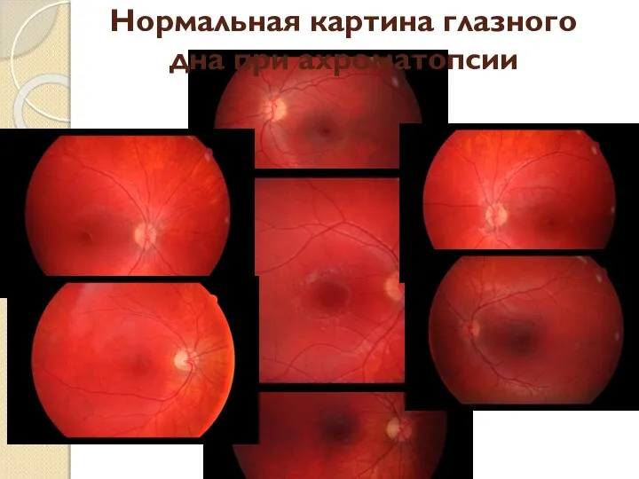 Нормальная картина глазного дна при ахроматопсии