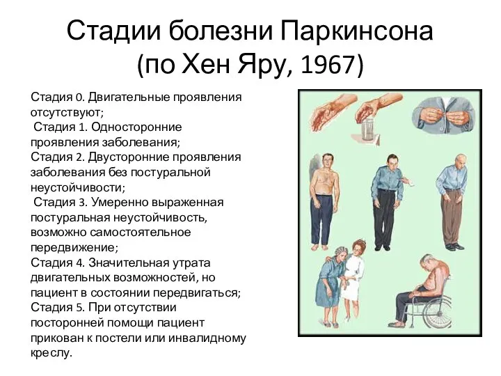 Стадии болезни Паркинсона (по Хен Яру, 1967) Стадия 0. Двигательные проявления отсутствуют;