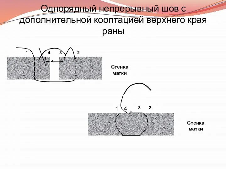 Однорядный непрерывный шов с дополнительной кооптацией верхнего края раны 1 2 3