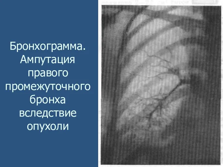 Бронхограмма. Ампутация правого промежуточного бронха вследствие опухоли