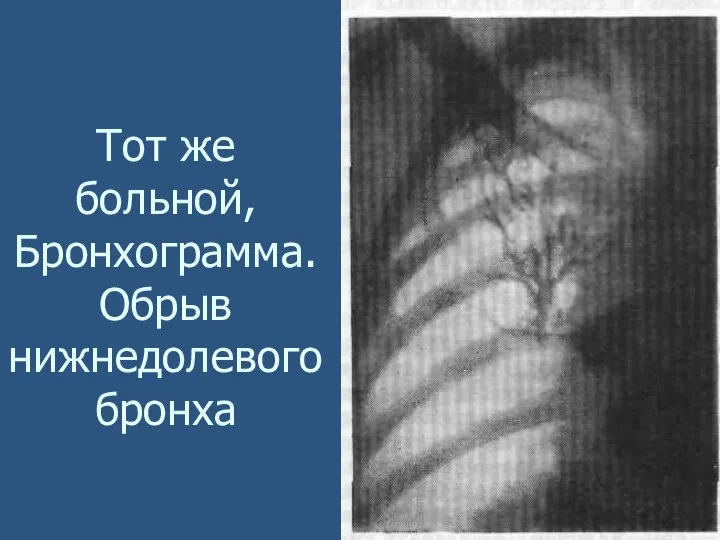 Тот же больной, Бронхограмма. Обрыв нижнедолевого бронха