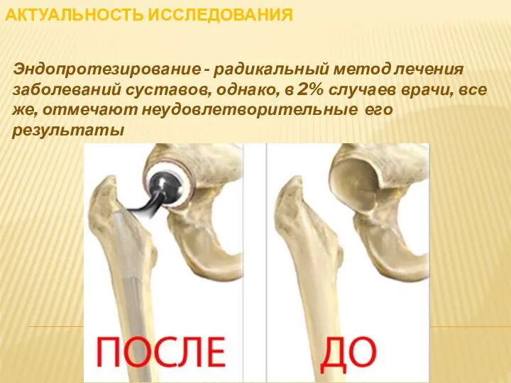 АКТУАЛЬНОСТЬ ИССЛЕДОВАНИЯ Эндопротезирование - радикальный метод лечения заболеваний суставов, однако, в 2%