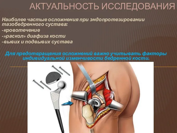 Наиболее частые осложнения при эндопротезировании тазобедренного сустава: -кровотечение -»раскол» диафиза кости -вывих