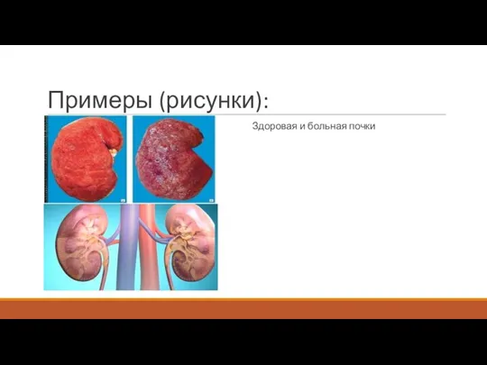 Примеры (рисунки): Здоровая и больная почки