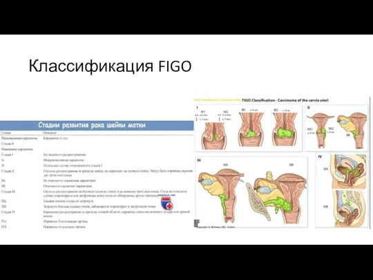 Классификация FIGO