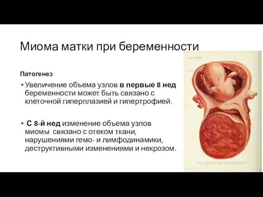 Миома матки при беременности Патогенез Увеличение объема узлов в первые 8 нед