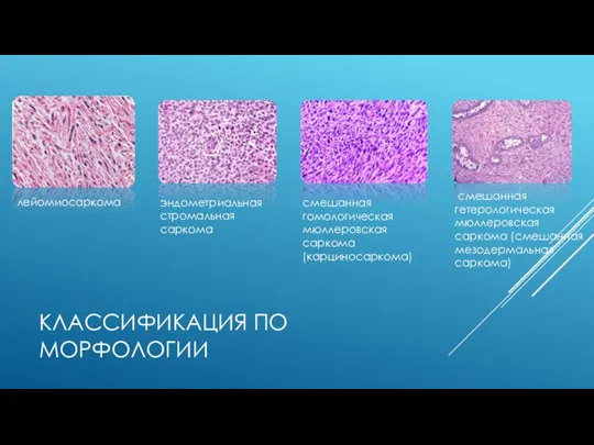 КЛАССИФИКАЦИЯ ПО МОРФОЛОГИИ лейомиосаркома эндометриальная стромальная саркома смешанная гомологическая мюллеровская саркома (карциносаркома)