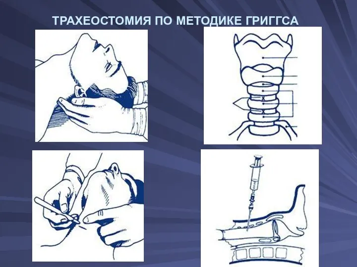 ТРАХЕОСТОМИЯ ПО МЕТОДИКЕ ГРИГГСА