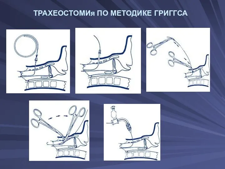 ТРАХЕОСТОМИя ПО МЕТОДИКЕ ГРИГГСА