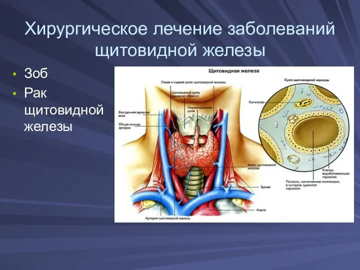 Хирургическое лечение заболеваний щитовидной железы Зоб Рак щитовидной железы