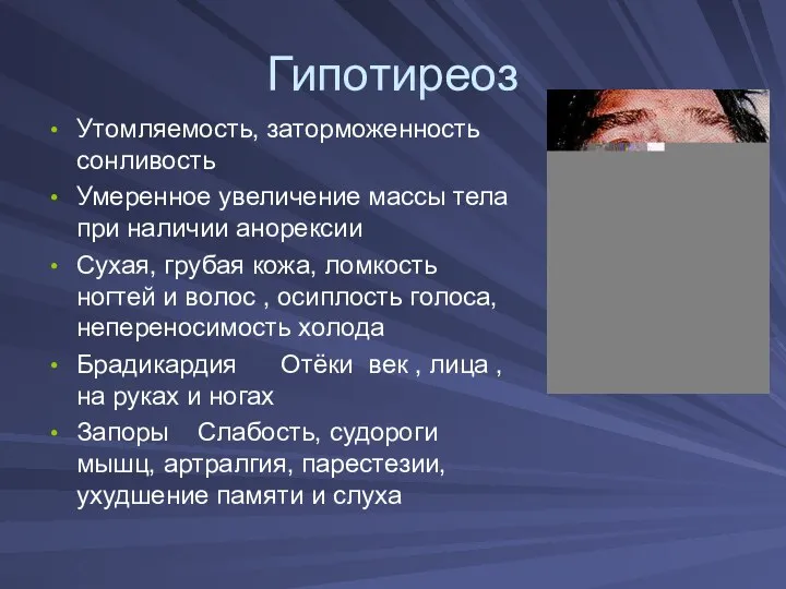 Гипотиреоз Утомляемость, заторможенность сонливость Умеренное увеличение массы тела при наличии анорексии Сухая,