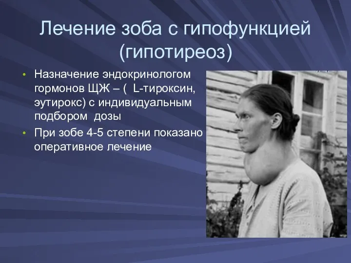 Лечение зоба с гипофункцией (гипотиреоз) Назначение эндокринологом гормонов ЩЖ – ( L-тироксин,