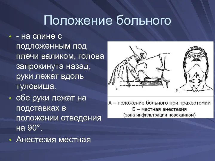 Положение больного - на спине с подложенным под плечи валиком, голова запрокинута