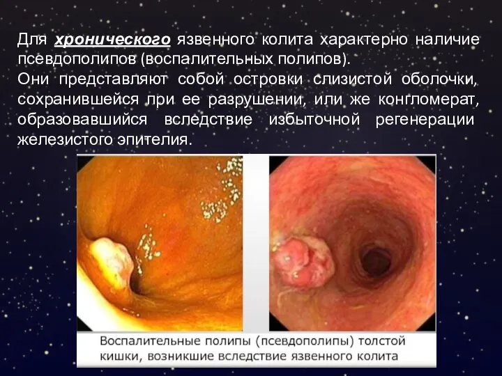 Для хронического язвенного колита характерно наличие псевдополипов (воспалительных полипов). Они представляют собой