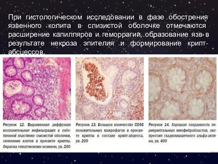 При гистологическом исследовании в фазе обострения язвенного колита в слизистой оболочке отмечаются