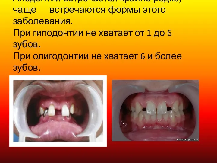 Анодонтия встречается крайне редко, чаще встречаются формы этого заболевания. При гиподонтии не