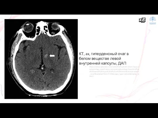 КТ, ax, гиперденсный очаг в белом веществе левой внутренней капсулы, ДАП https://www.uptodate.com/contents/traumatic-brain-injury-epidemiology-classification-and-pathophysiology?search=diffuse%20axonal%20injury%20diffusion%20tensor&source=search_result&selectedTitle=2~150&usage_type=default&display_rank=2