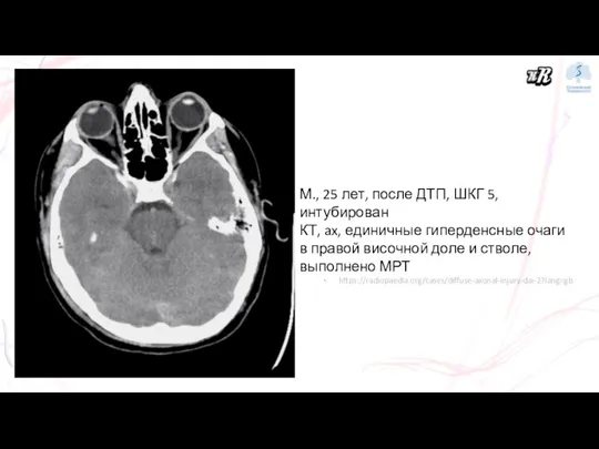М., 25 лет, после ДТП, ШКГ 5, интубирован КТ, ax, единичные гиперденсные