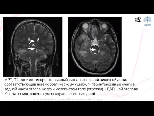 МРТ, Т2, cor и ax, гиперинтенсивный сигнал от правой височной доли, соответствующий