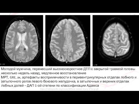 Молодой мужчина, перенесший высокоскоростное ДТП с закрытой травмой головы несколько недель назад,