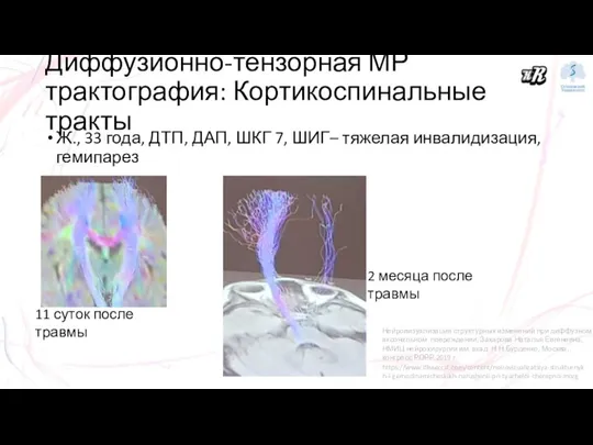 Ж., 33 года, ДТП, ДАП, ШКГ 7, ШИГ– тяжелая инвалидизация, гемипарез Диффузионно-тензорная