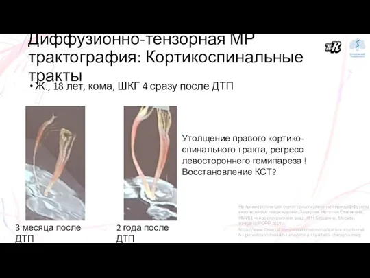 Ж., 18 лет, кома, ШКГ 4 сразу после ДТП Диффузионно-тензорная МР трактография: