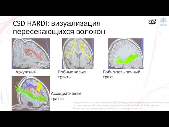 CSD HARDI: визуализация пересекающихся волокон Аркуатный тракт Лобные косые тракты Лобно-затылочный тракт