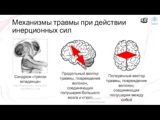 Механизмы травмы при действии инерционных сил Продольный вектор травмы, повреждение волокон, соединяющих