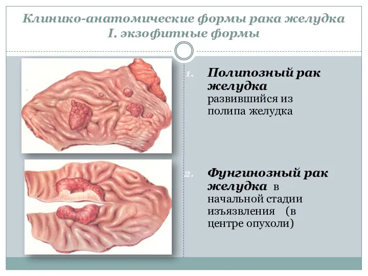 Клинико-анатомические формы рака желудка I. экзофитные формы Полипозный рак желудка развившийся из