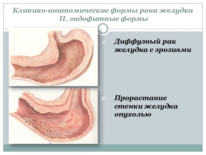 Диффузный рак желудка с эрозиями Прорастание стенки желудка опухолью Клинико-анатомические формы рака желудка II. эндофитные формы