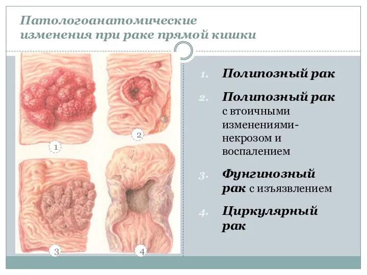 Полипозный рак Полипозный рак с втоичными изменениями- некрозом и воспалением Фунгинозный рак