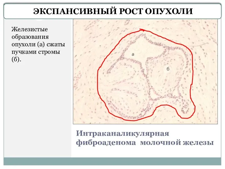 Интраканаликулярная фиброаденома молочной железы Железистые образования опухоли (а) сжаты пучками стромы (б). ЭКСПАНСИВНЫЙ РОСТ ОПУХОЛИ