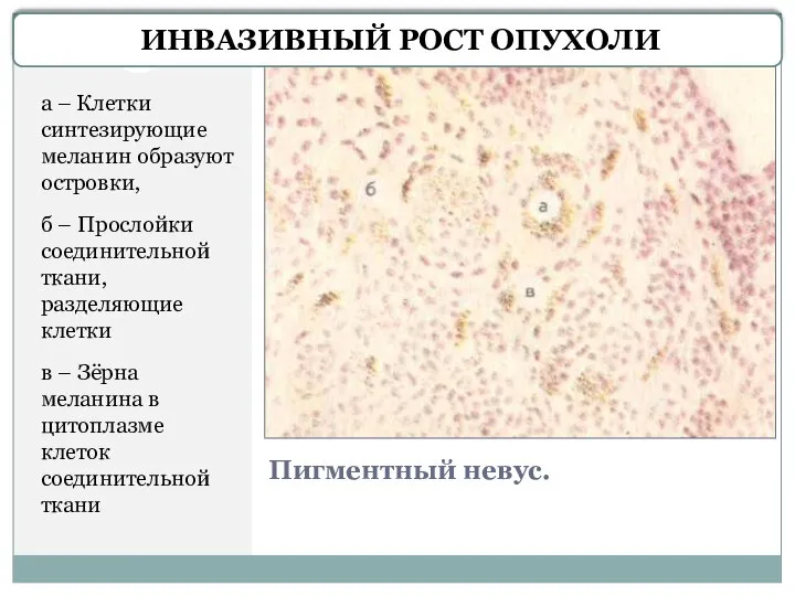 Пигментный невус. а – Клетки синтезирующие меланин образуют островки, б – Прослойки