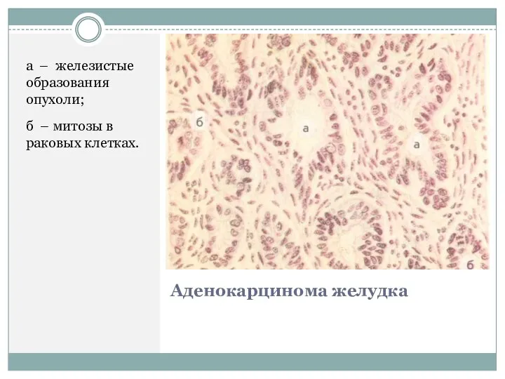 Аденокарцинома желудка a – железистые образования опухоли; б – митозы в раковых клетках.