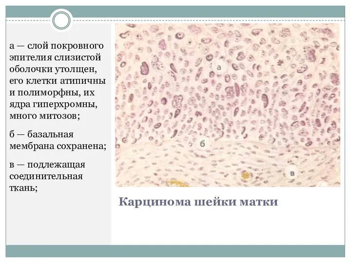 Карцинома шейки матки а — слой покровного эпителия слизистой оболочки утолщен, его