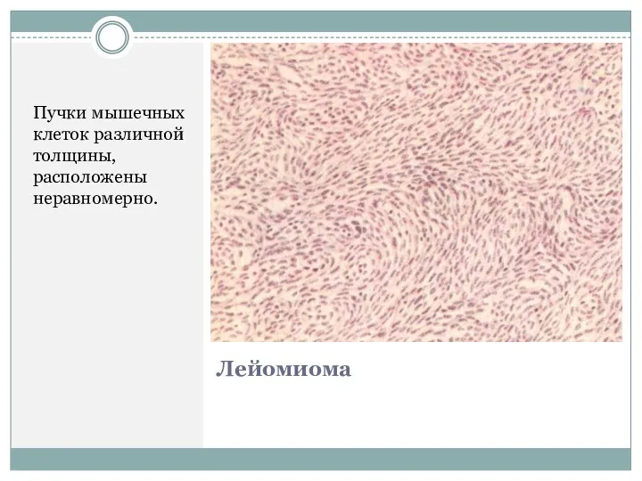 Лейомиома Пучки мышечных клеток различной толщины, расположены неравномерно.