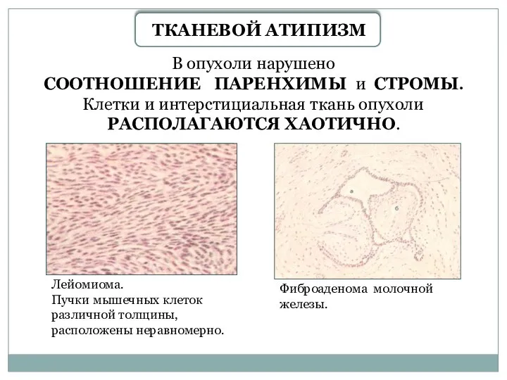 ТКАНЕВОЙ АТИПИЗМ В опухоли нарушено СООТНОШЕНИЕ ПАРЕНХИМЫ и СТРОМЫ. Клетки и интерстициальная